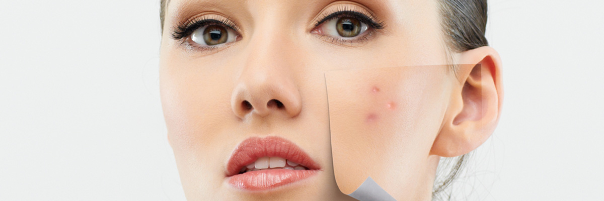 Rosacea Treatment