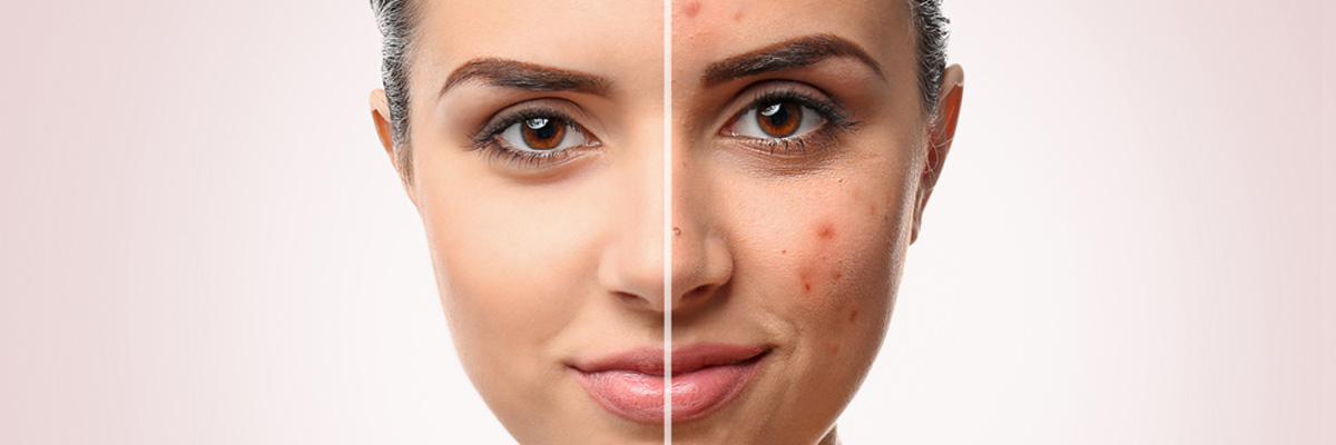 Acne Before After