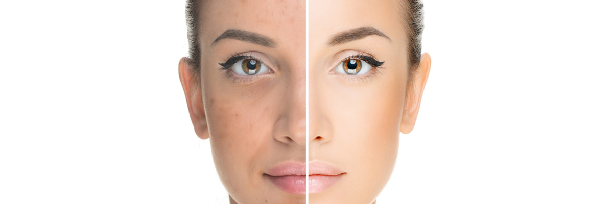 Acne Before After