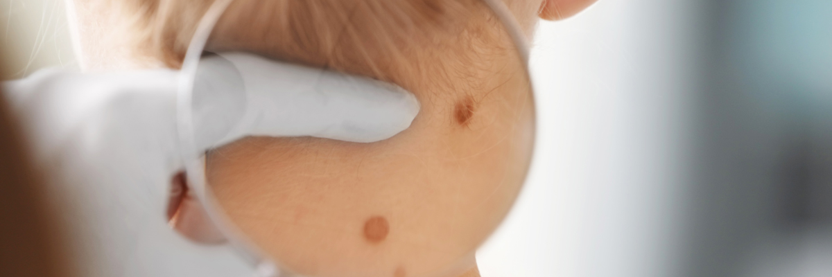 Dermatologist examining birthmark of patient