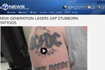New generation lasers zap stubborn tattoos in ABC 7 News, 22nd April 2014