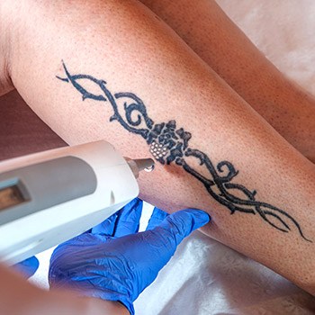 Ways to remove tattoos