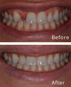 Before After Case - 1