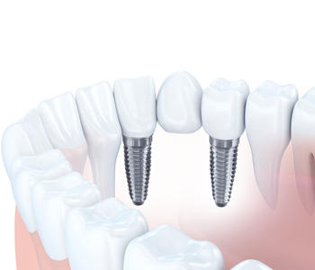 Dental implant bridge