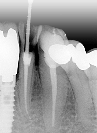 Illustration of Root Canals