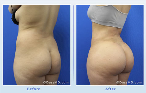 Brazilian butt lift surgery helps patients achieve a shapelier body with curves