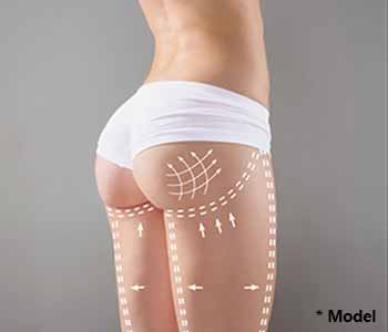 buttock augmentation in Beverly Hills, CA