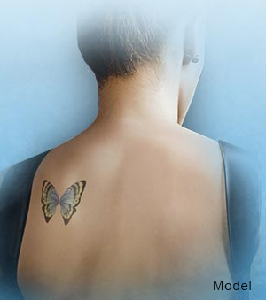 Laser Tattoo Removal Dr Dennis Dass MD, Dass MD.com