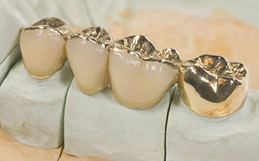 Dental Bridges 