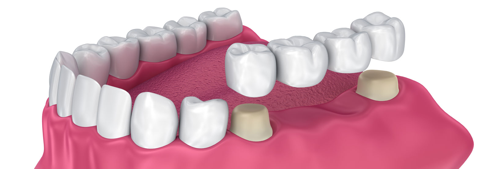 Dental Bridges
