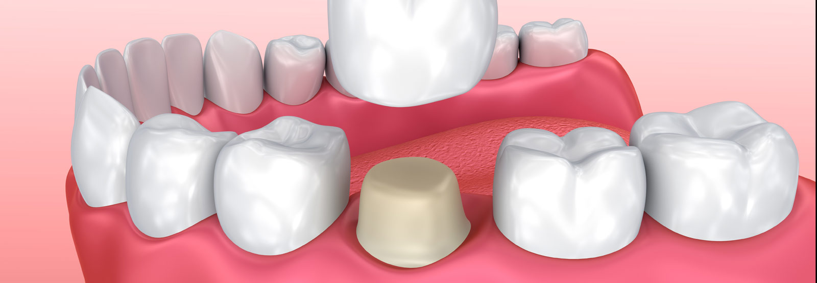 Dental Crowns