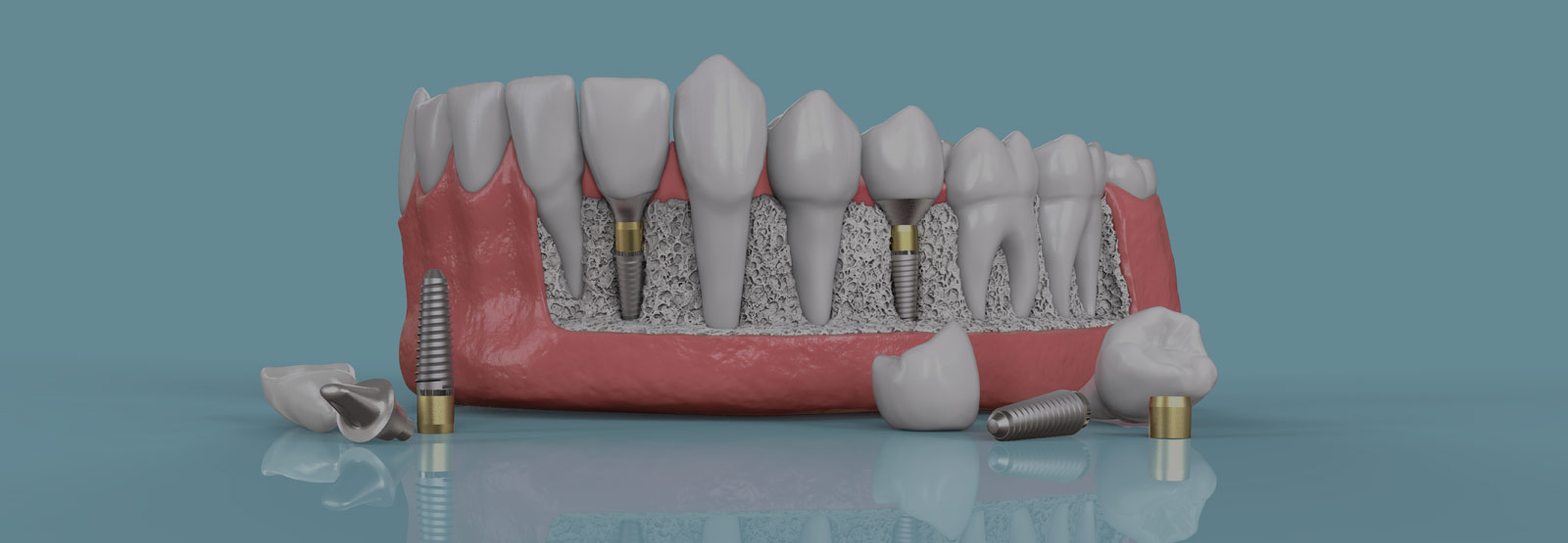 Dental implant