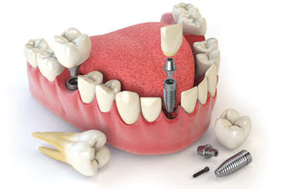 Comprehensive care “near me” in Dolton, IL includes dental implants