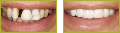 Crowns and Bridges Wayne - Crowns & Bridges Before and After Gallery Image 1