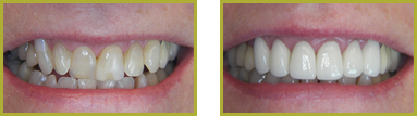 Crowns and Bridges Wayne - Crowns & Bridges Before and After Gallery Image 2