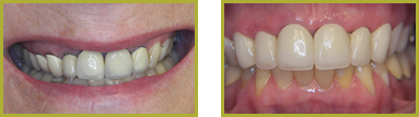 Crowns and Bridges Wayne - Crowns & Bridges Before and After Gallery Image 3