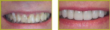 Crowns and Bridges Wayne - Crowns & Bridges Before and After Gallery Image 4