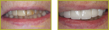Crowns and Bridges Wayne - Crowns & Bridges Before and After Gallery Image 6
