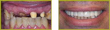 Crowns and Bridges Wayne - Crowns & Bridges Before and After Gallery Image 7