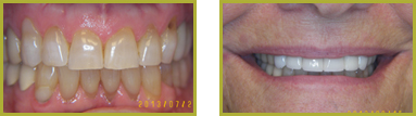 Crowns and Bridges Wayne - Crowns & Bridges Before and After Gallery Image 5