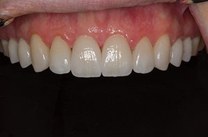 Veneers after  01