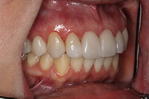 Veneers  After 02