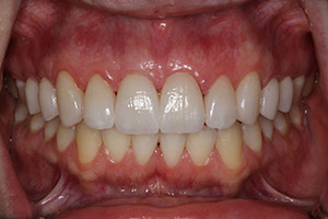 Veneers  After 03