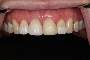 Veneers before  01