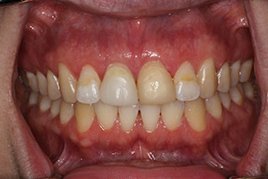 Veneers  Before 03