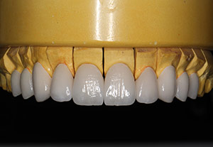 Veneers  Model