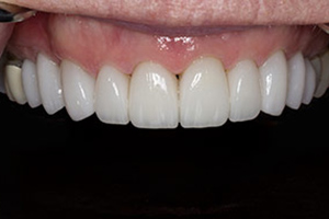 Veneers  after 04
