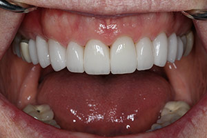 Veneers  after 05