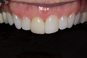 Veneers  before 04
