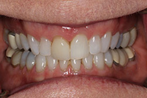 Veneers  before 05