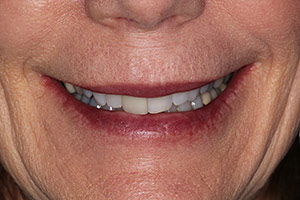 Veneers  before 06