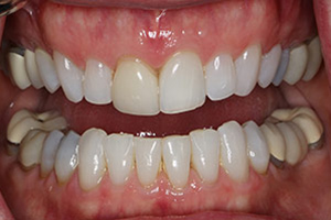 Veneers  before 07