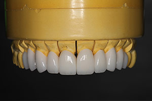 Veneers  Model 02