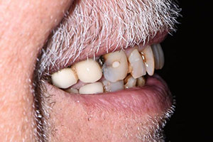 Veneers  before 09