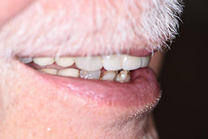 Veneers  after 09