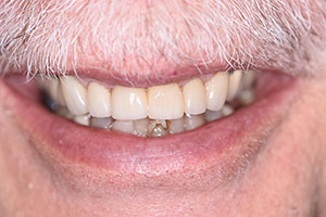 Veneers  after 08