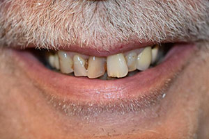 Veneers  before 08