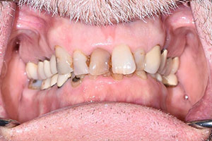 Veneers  before 10