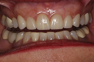 Veneers  after 12