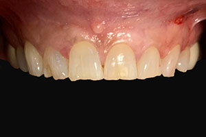 Veneers  before 11