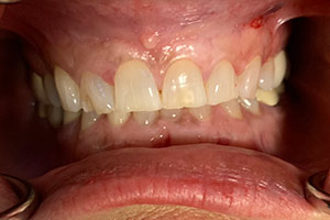 Veneers  before 12