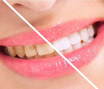 The process of in-office teeth whitening