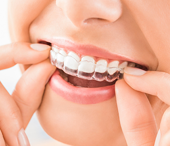 Dr. Gordon Kent at The Smile Center in Buffalo explains how to treat crooked teeth