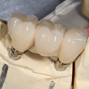 Dental Crowns Charleston SC Photo