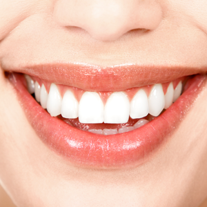 Dental Veneers Charleston SC Photo