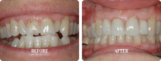 Before After Veneers
